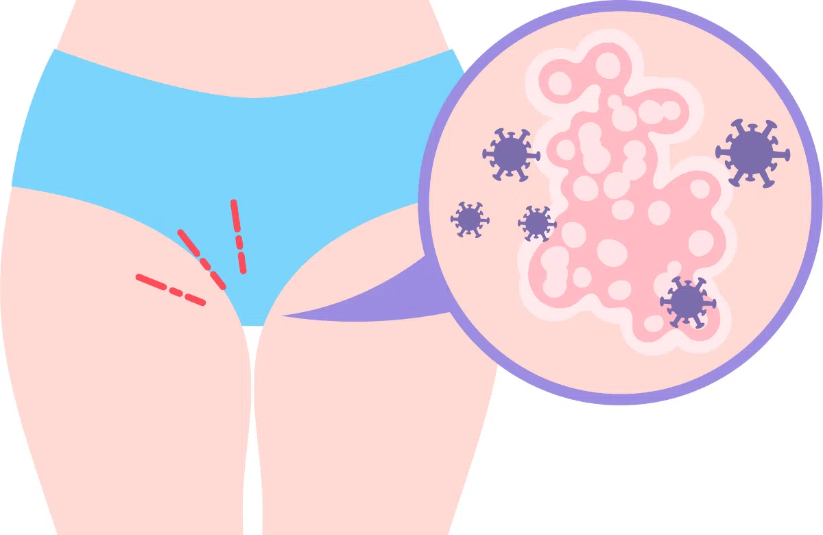 Vùng kín ẩm ướt trước kỳ kinh: Nguyên nhân và cách xử lý