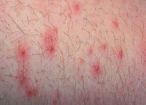 Vùng kín bị ngứa nổi mẩn đỏ: Nguyên nhân và cách điều trị