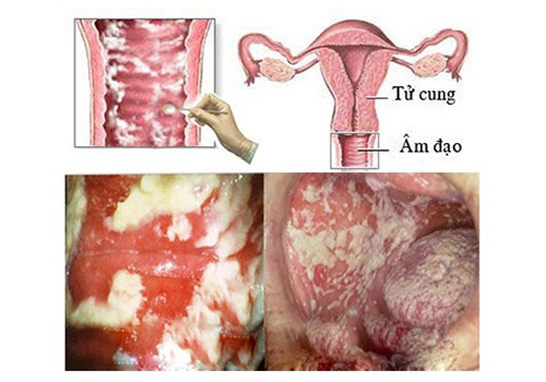 Vùng kín bị ngứa và nổi hạt: Nguyên nhân và cách điều trị
