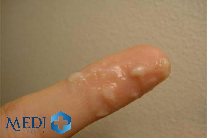 Vùng kín chảy nước màu trắng đục: Nguyên nhân và cách xử lý
