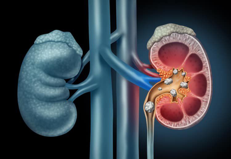 Kidney Stones Gallery 1