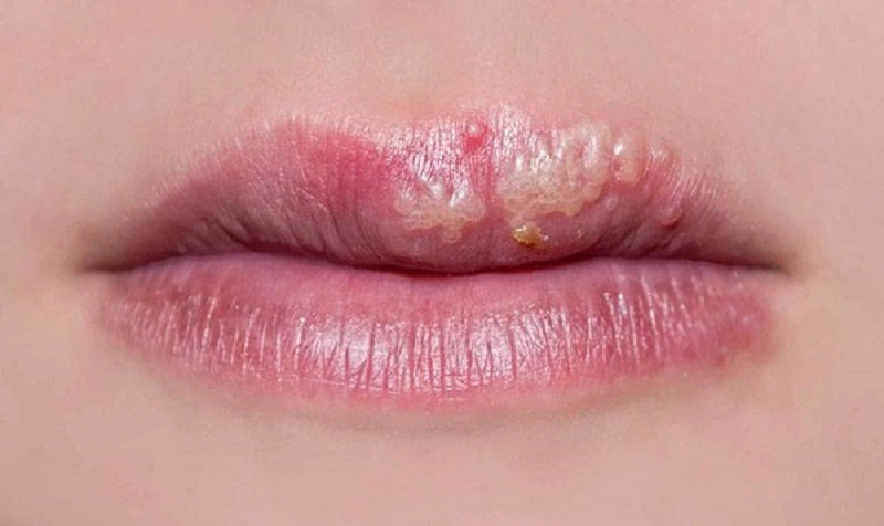 Xăm môi bị bọng nước phải làm sao?