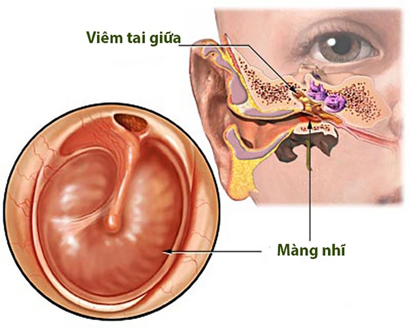 Xì mũi nhiều bị ù tai: Nguyên nhân và cách khắc phục