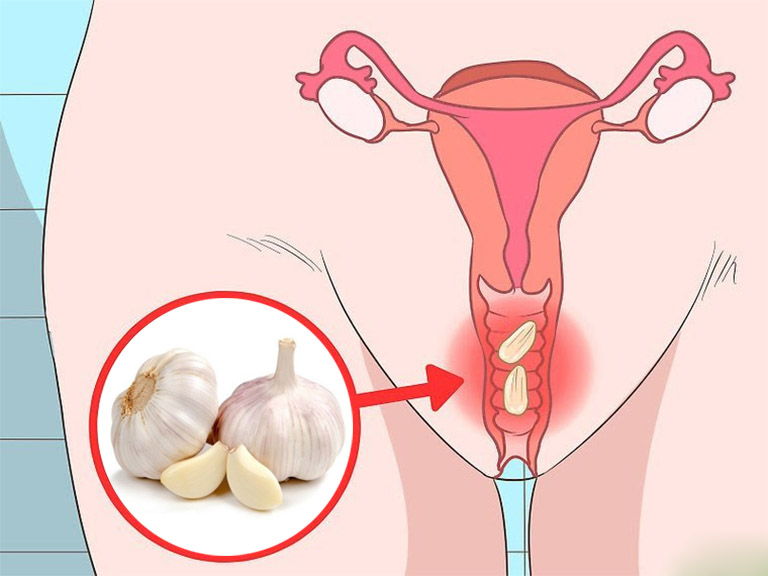 Xông Tỏi Vùng Kín Có Tác Dụng Gì?
