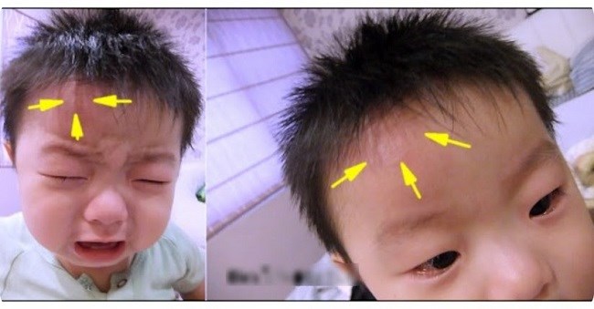 Trẻ bị té u đầu phải làm sao? Gallery 2