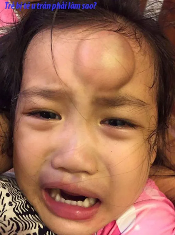 Trẻ bị té u đầu phải làm sao? Gallery 1