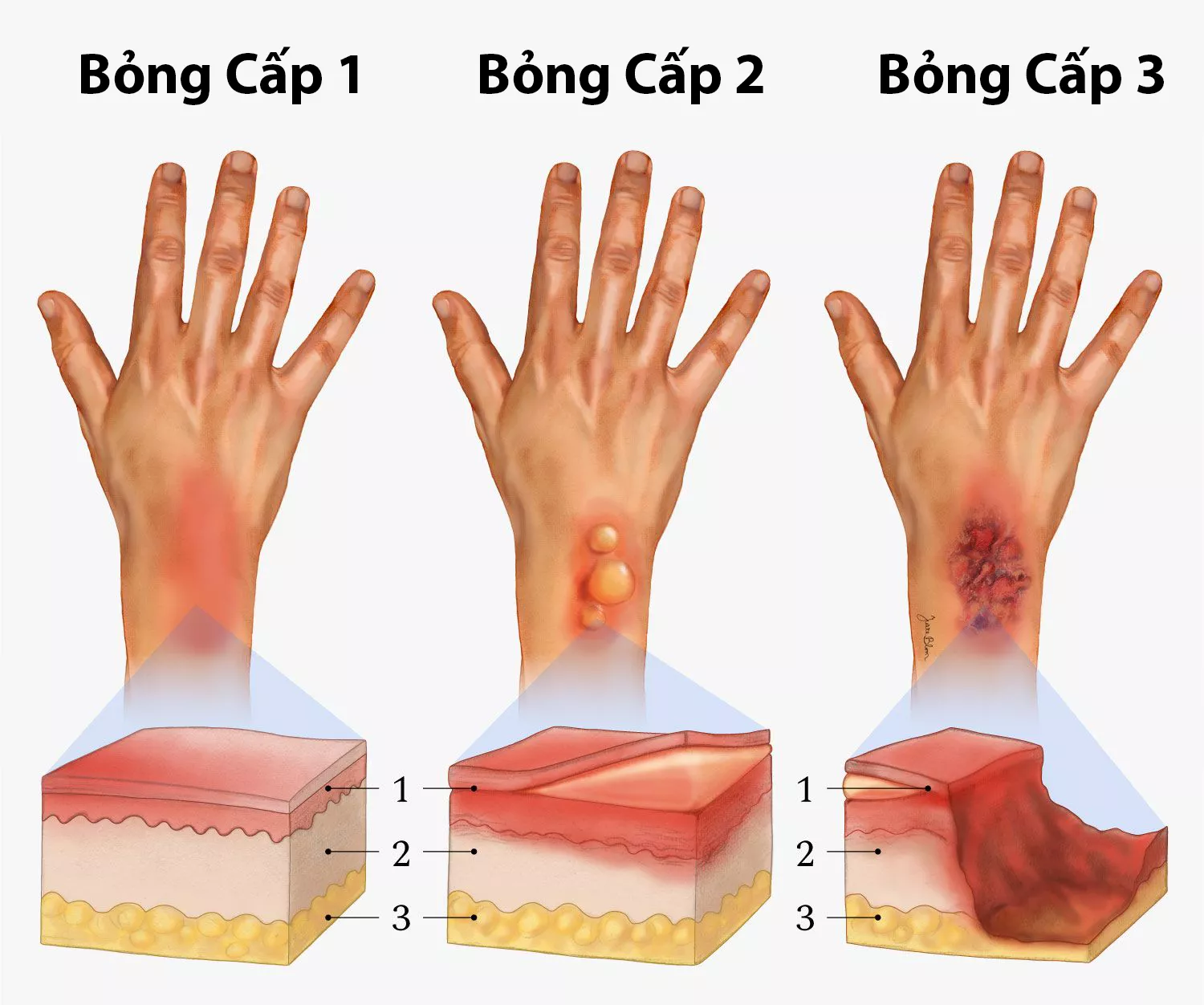 Bị phỏng nên bôi gì? Gallery 1