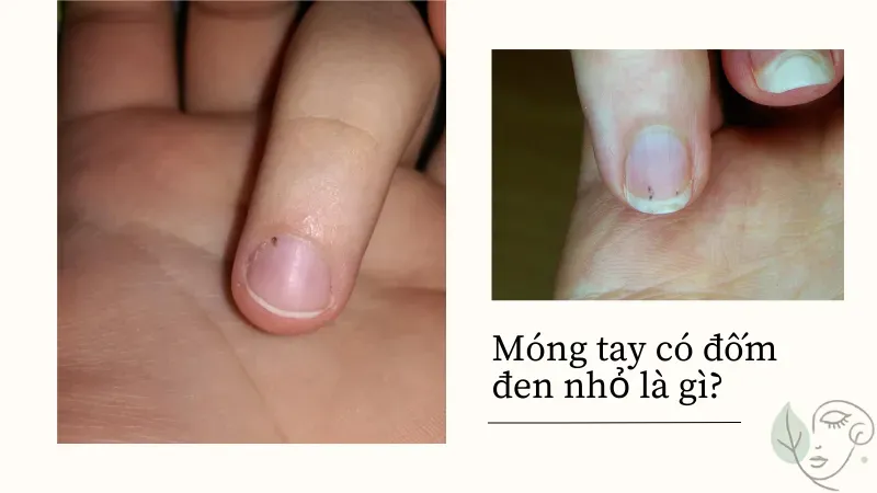 Xuất hiện đốm đen trên móng tay: Nguyên nhân và cách xử lý