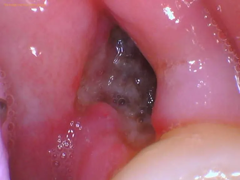 Xuất hiện màng trắng sau khi nhổ răng: Nguyên nhân và cách xử lý