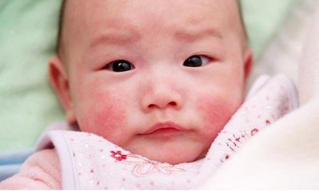 Xung quanh miệng nổi mẩn đỏ: Nguyên nhân và cách điều trị