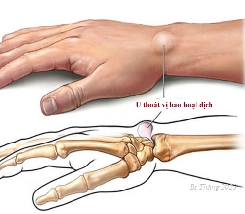 Xương Lồi Ở Cổ Tay: Nguyên Nhân, Triệu Chứng Và Điều Trị