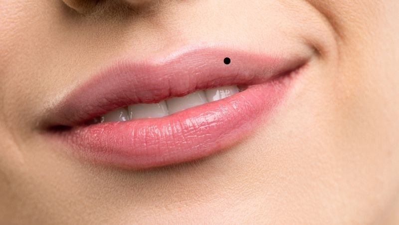 Mụn Ruồi Dưới Môi: Ý Nghĩa, Nguyên Nhân và Cách Xử Lý Gallery 1