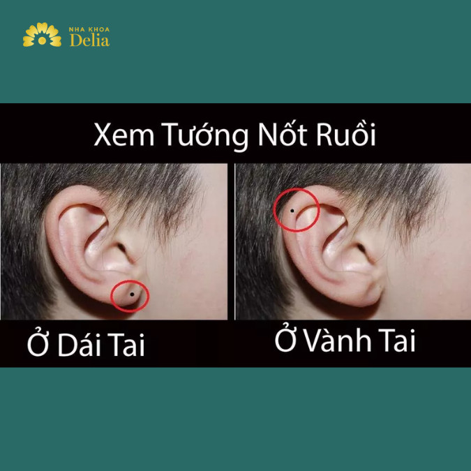Mụn Ruồi Ở Tai Trái Nam: Ý Nghĩa Và Những Điều Cần Biết Gallery 1