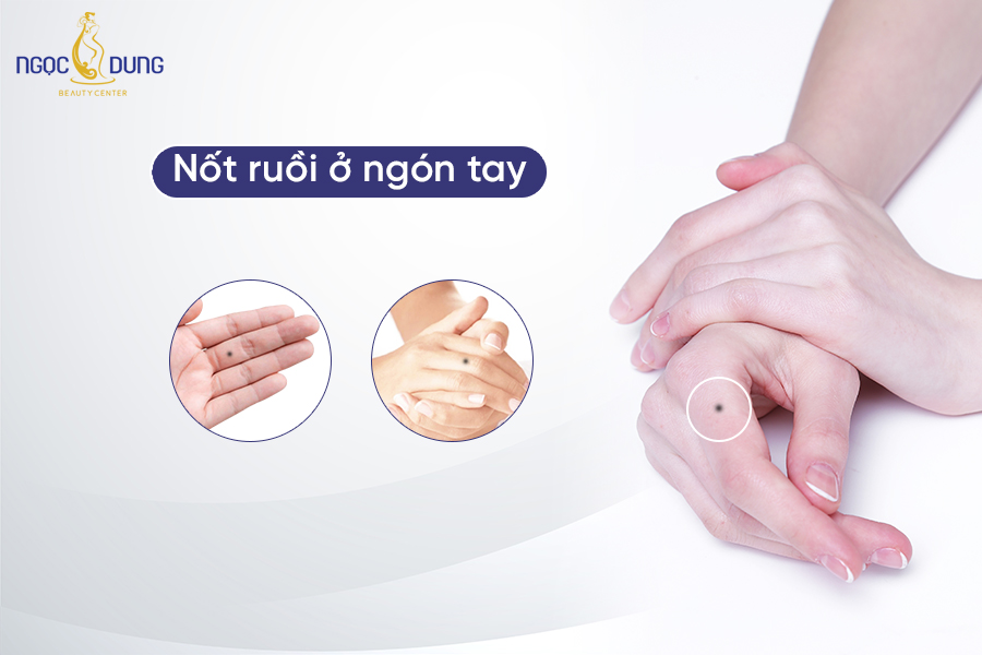 Mụn Ruồi Ở Tay Phải Nữ: Ý Nghĩa Và Điều Cần Biết Gallery 1