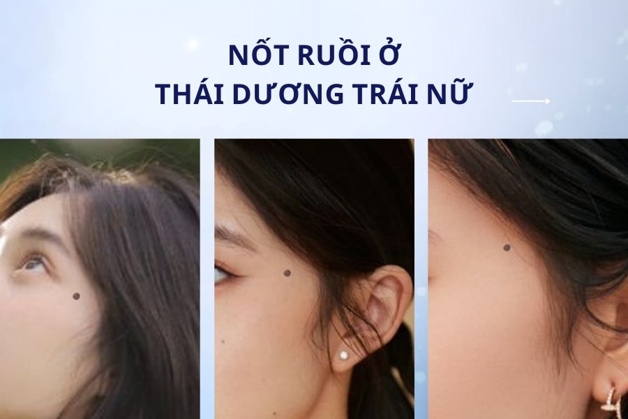 Mụn Ruồi Ở Thái Dương: Ý Nghĩa, May Mắn Hay Xui Xẻo? Gallery 1