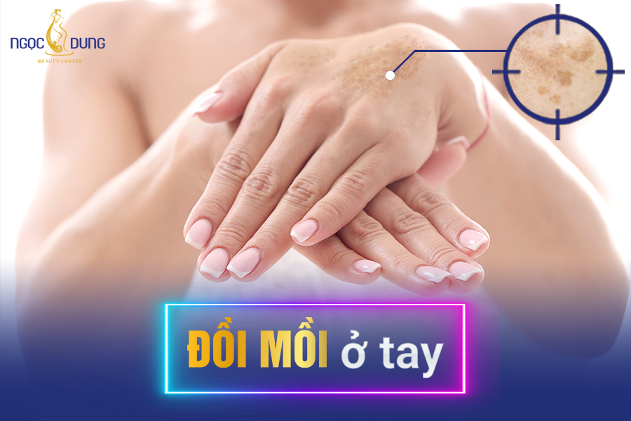 Đồi Mồi Ở Tay Người Trẻ: Ý Nghĩa, Xu Hướng Và Cách Chọn Mẫu Đẹp Gallery 1