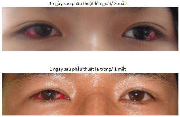 Sẽ lé là gì? Gallery 1