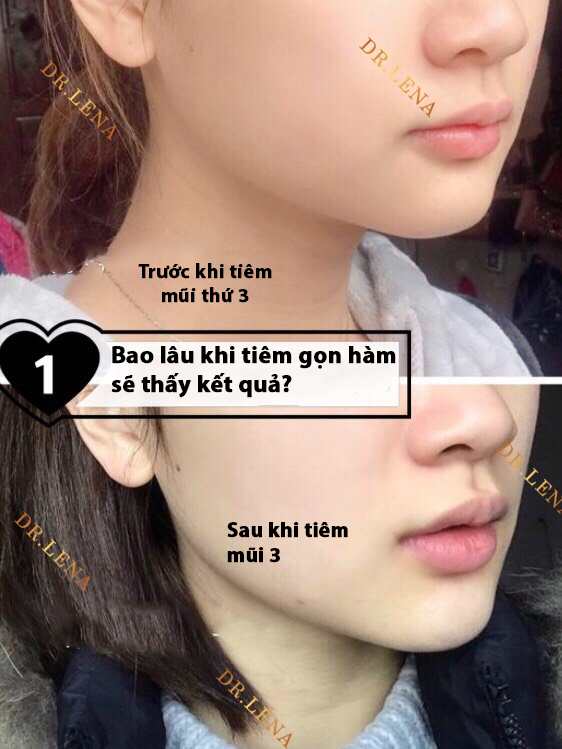 Tiêm Gọn Hàm Bao Lâu Thì Gọn? Gallery 2