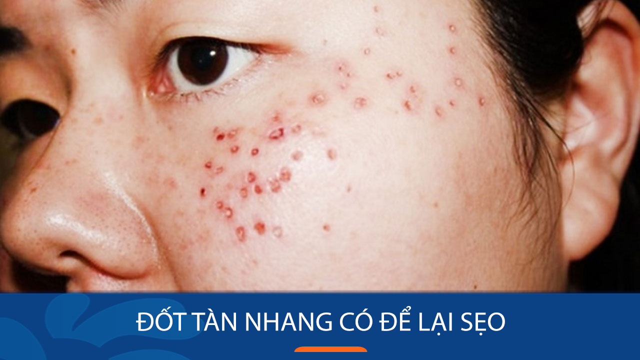 Chấm tàn nhang có để lại sẹo không? Gallery 1