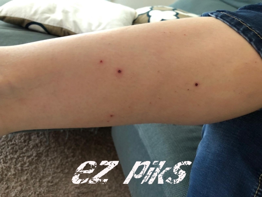 Skin Lesions