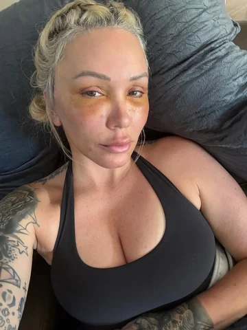 Just got my stitches out- day 5. New face, who dis? 

(Also how cute is my hubby