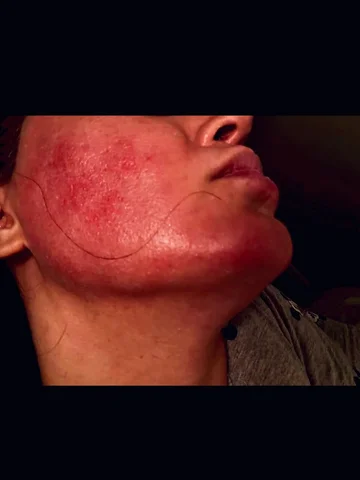 ⁨	⁨	⁨	⁨	⁨	⁨	گاهی «کورتون » تزریق می کردم تا التهاب پوست صورتم بخاطر چسب های گریم