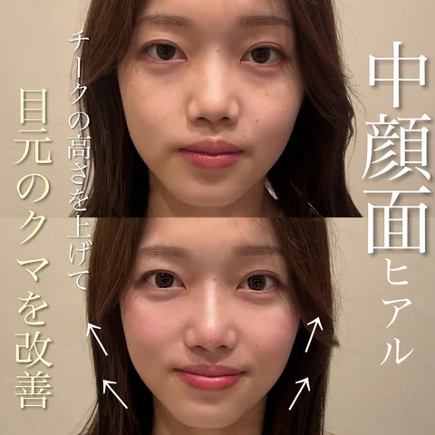 カスタマイズヒアルで
"お顔のバランスを整える"

周りにはバレずに自然な垢抜け☺︎

"たった1本の注射にも無限の可能性を"

どんなお悩みでも構いません
僕
