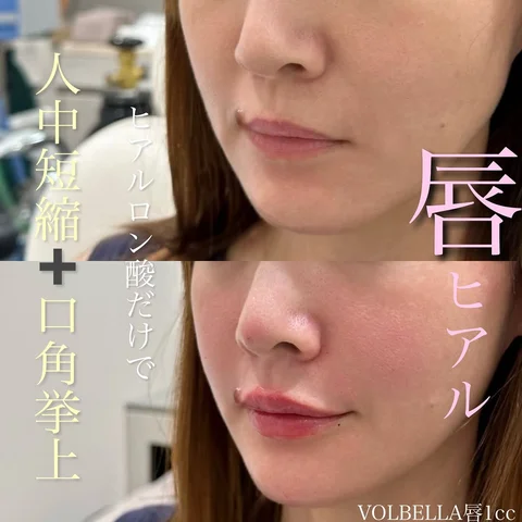 💎
Dr.紀田のヒアルロン酸(唇)
#唇ヒアルロン酸
#人中短縮 

#紀田ヒアル

唇ヒアルロン酸で
憧れのぷるぷるリップ👄🤍

そしてヒアルロン酸でC