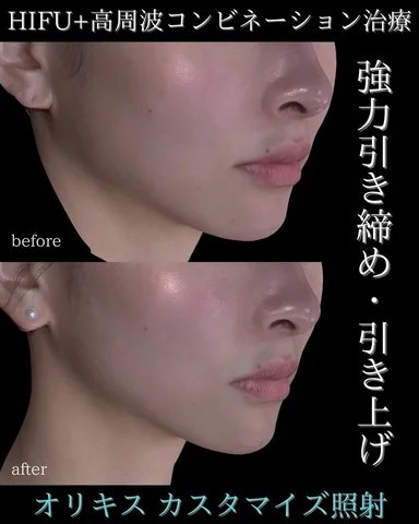 ⭐️オリジオキス（Oligio Kiss）
HIFU✖️高周波（RF）を組み合わせた最新のたるみ治療です。

HIFUでSMAS層までしっかり引き上げつつ、
高