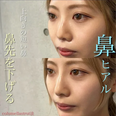 🌈ヒアルで劇的変化🌈
💎モニター予約殺到中✨

Dr.紀田のヒアルロン酸(鼻)
《columella strut法》

#鼻ヒアルロン酸ならdr紀田 
#
