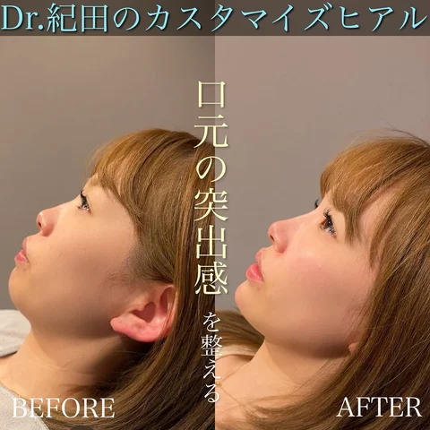 カスタマイズヒアルで
"お顔のバランスを整える"

周りにはバレずに自然な垢抜け☺︎

"たった1本の注射にも無限の可能性を"

どんなお悩みでも構いません
僕