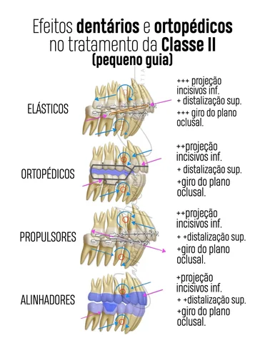 Cada aparelho e cada terapia têm as suas particularidades, e na Classe II não é 