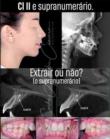 Overjet de 7 mm, Classe II e com um dente supranumerário por palatino dos incisi