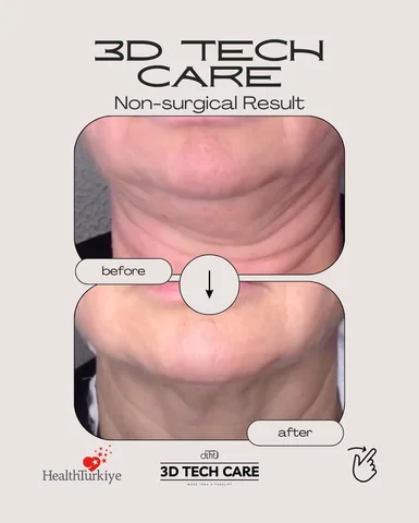 With our new 3D TECH CARE non-surgical rejuvenation
package prepared according t