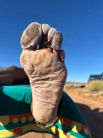 Most people look at my feet after a race and cringe. Blisters, missing and black