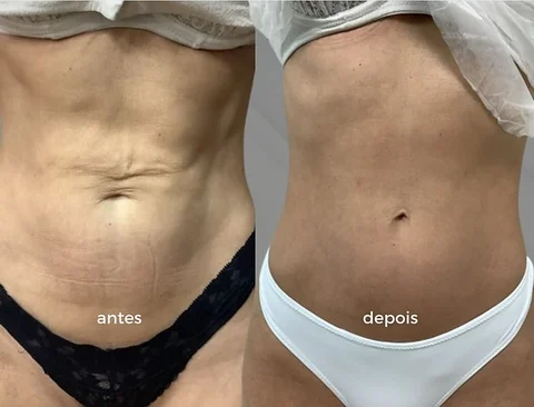 "Um antes e depois que fala por si só! Biostimuladores e ácido hialurônico de vá