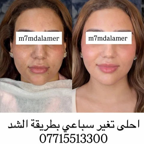 ⁨	⁨	الكيكة بعد التغير السباعي وحقن الفلر بطريقة الشد #ابرة فلر تغير سباعي 200 ال