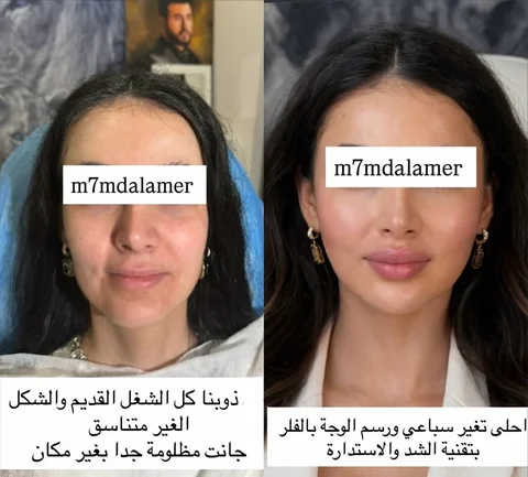 ⁨	الكيكة بعد التغير السباعي وحقن الفلر بطريقة الشد #ابرة فلر تغير سباعي 200 الف 