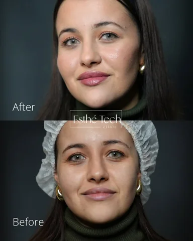 Full face treatment before & after ✨✨

📍esthetech, said hamdine 

#fullface #me