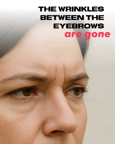 The vertical lines between your eyebrows — the “11s” — form mainly from repeated