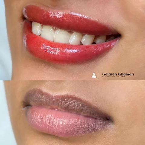 Dark Lips Correction – Right After ✨

Right after the procedure, the color may l