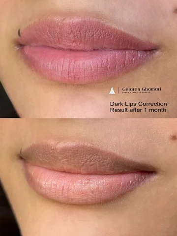 Dark Lips Correction — healed result after one month.

With over 10 years of exp