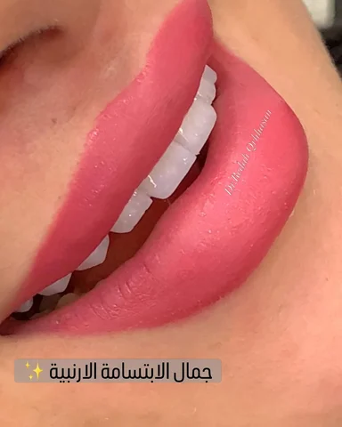 لما تكون الأسنان الأمامية بطلتها المميزة… يطلع لنا سحر الابتسامة الأرنبية 👑👑