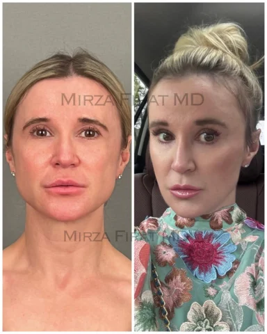 I received an updated photo today from my dear patient who underwent a full-face