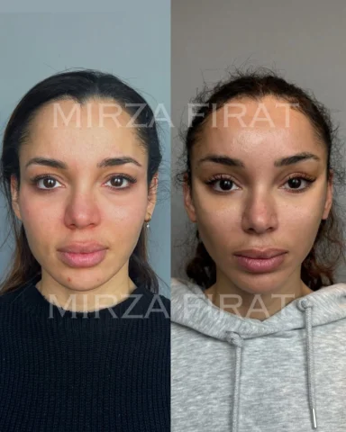 ✨ FıratLift Type V — 1 Week Result ✨ 
💫 Just one week after FıratLift Type V, w