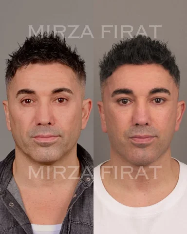 Two and a half months ago, I performed a Hybrid Full Facelift + Neck Lift + Lowe