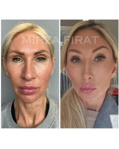 One year ago, I performed an endoscopic deep-plane face and neck lift (FıratLift