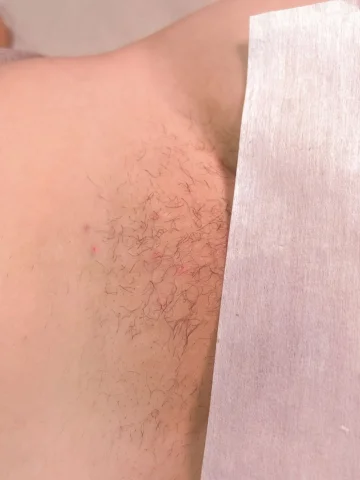 Foliculite na virilha não é “normal”. É comum e tem tratamento. ✨

Bolhas inflam