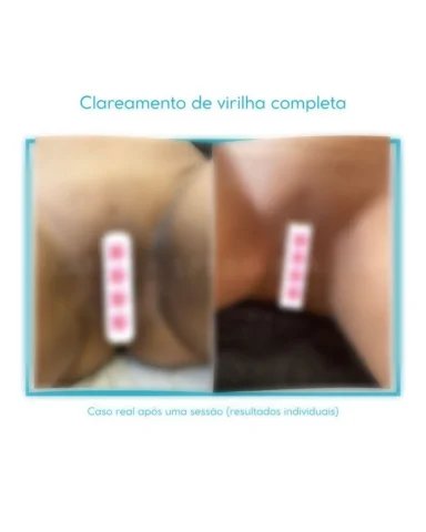 Evolução após 1 sessão de Peeling Rose de Mer ✨
(Foto enviada pela cliente) 

O 