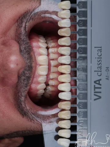 ⁨	درخشش یه لبخند مردانه با طبیعی ترین حالت ممکن لمینیت سرامیکی✨⁩

از روی اسلاید 